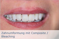Zahnumformung mit Composite / Bleaching